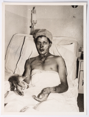 A Man Wounded by Bombings in Beirut During the War of the Camps, 1985-1988