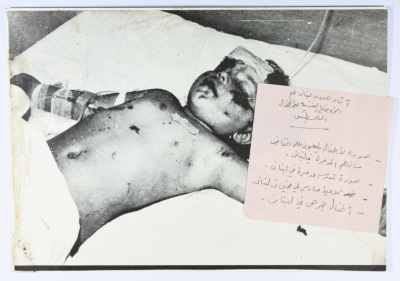 An Injured Boy Child, Lebanon, 1987