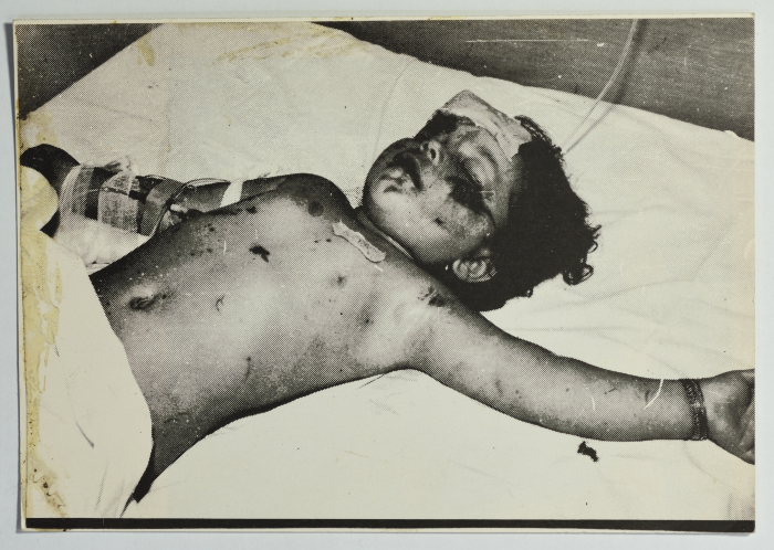 An Injured Boy Child, Lebanon, 1987