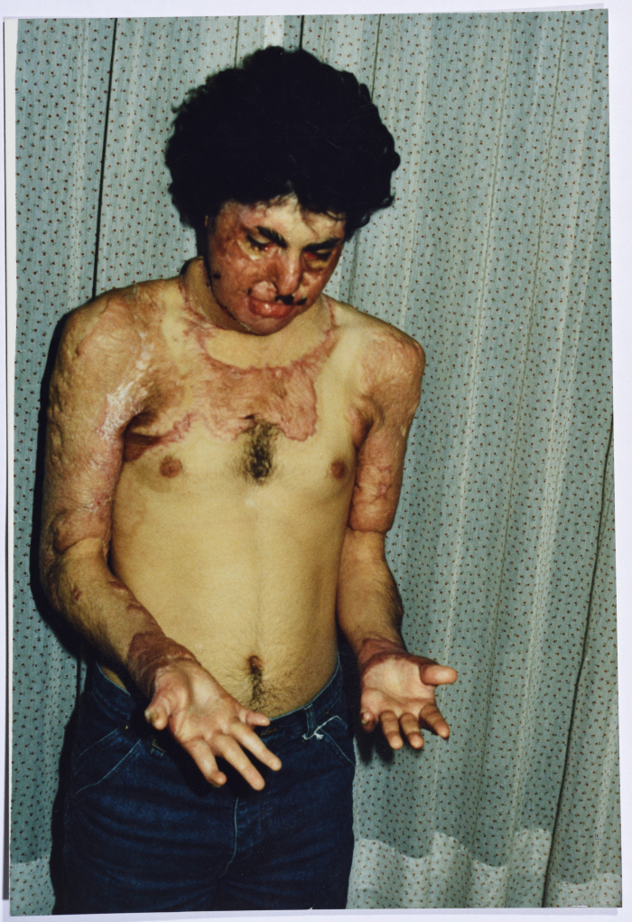آثار الحروق على جسد أحد المصابين في الاجتياح الاسرائيلي للبنان عام 1982