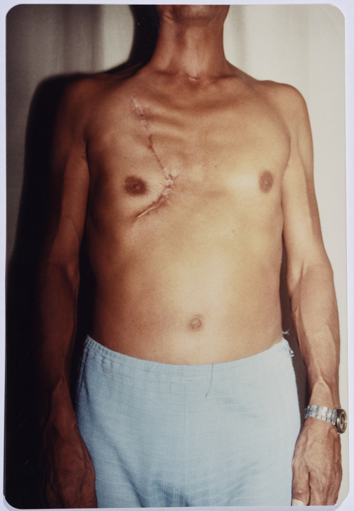 A Medical Surgery in the Chest After BeingInjured During the Israeli Invasion on Lebanon
