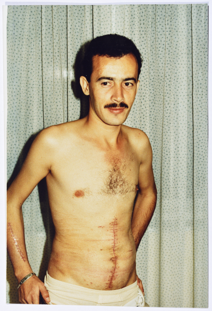 The Marks of the Medical Surgery on the body of one of the injured during the Israeli invasion on Lebanon  