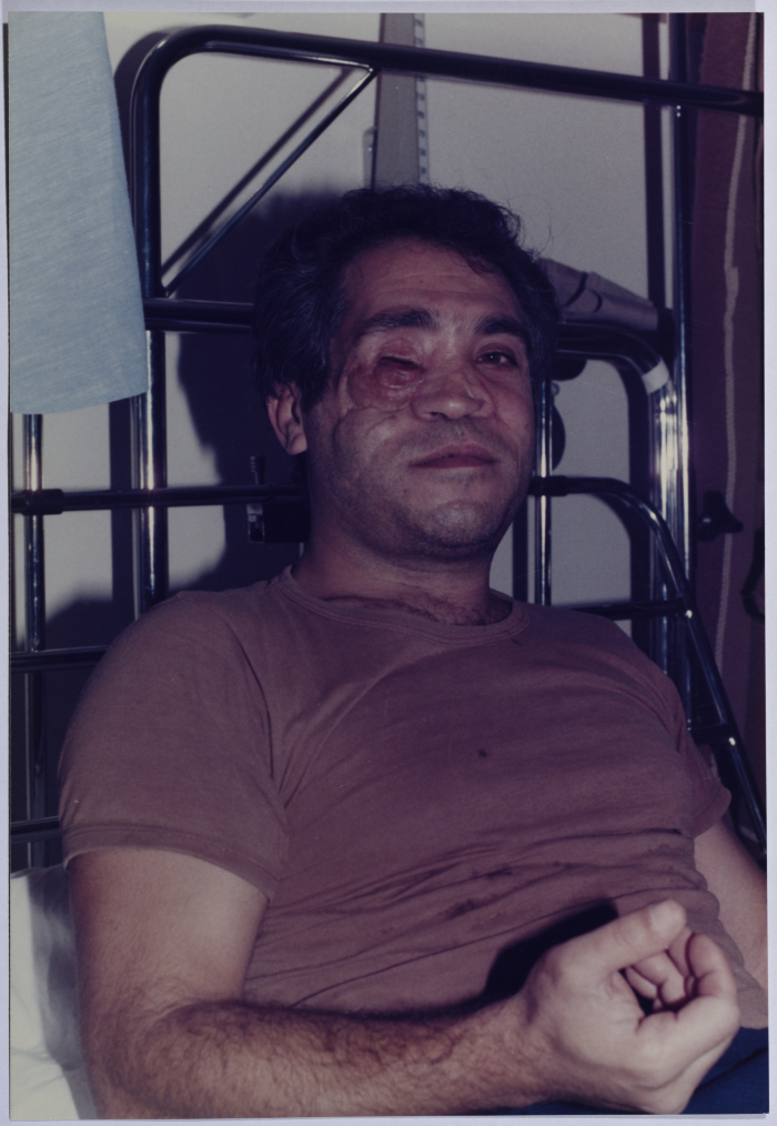 One of the Refugee Camp's Wounded During the Israeli Invasion on Lebanon in 1982 