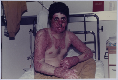 One of the Wounded During the Israeli Invasion on Lebanon in 1982-1985 
